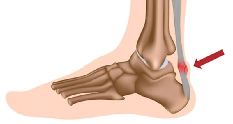 Achilles injuries