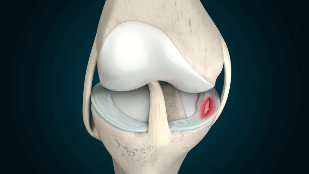 Meniscus tears